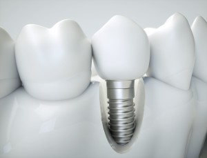 Les implants au cabinet dentaire du Dr Giraudo à Aix en Provence (13)