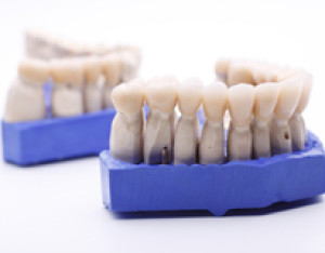 Les prothèses dentaires au cabinet dentaire du Dr Giraudo à Aix en Provence (13)